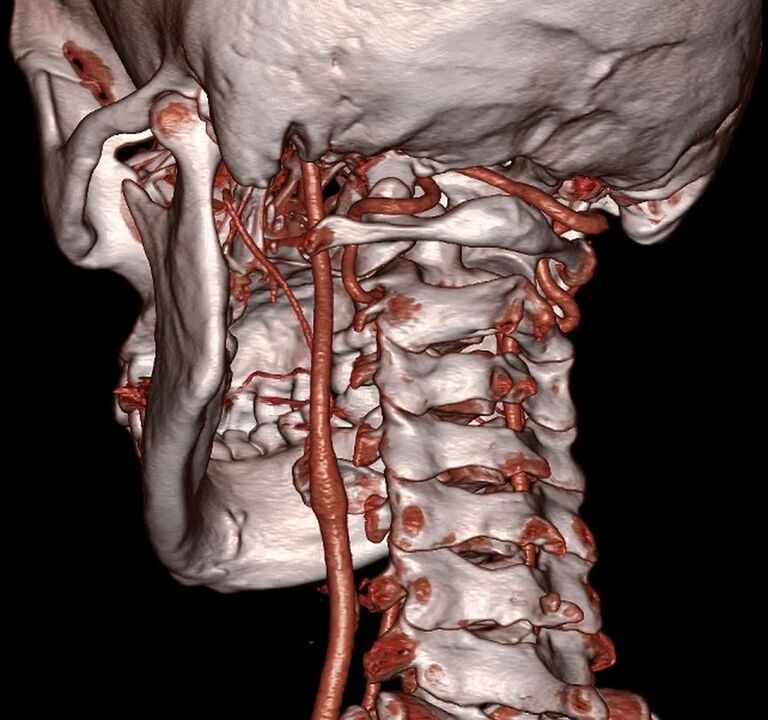 arteria pintxatua osteokondrosi zerbikalarekin