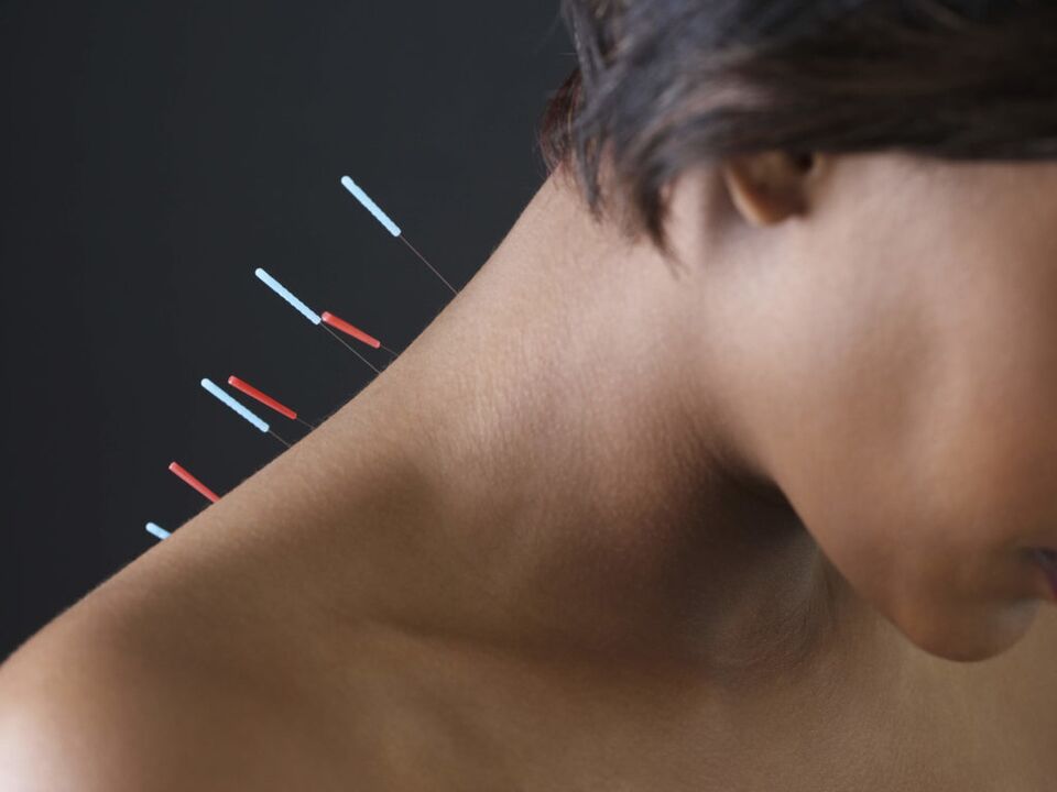 Trápaga osteokondrosiaren akupunturak hanturazko prozesuak ezabatzen ditu